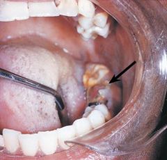 an excessive proliferation of chronically inflamed dental pulp tissue