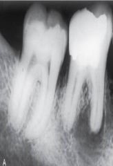 a localized mass of chronically inflamed granulation tissue that forms at the opening of the pulp canal, generally at the apex of a nonvital tooth root