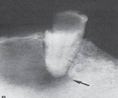 a true epithelium lined cavity


 


a result of proliferation of the rests of Malassez


 


usually asymptomatic