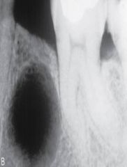 form when the tooth is removed and all or part of a radicular cyst is left behind