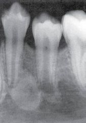 a change in bone near the apices of teeth that may be a reaction to low-grade infection


 


mandibular 1st molar most commonly assiciated