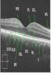 nerve fiber layer
ganglion cell layer
inner plexiform layer
inner nuclear layer
outer nuclear layer
retinal pigemented layer
choroid plexus