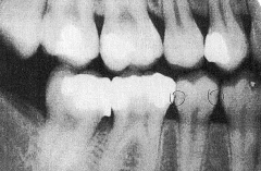 1) type of x-ray?
2) side of mouth?
3) teeth with restorations? 
4) tooth with caries?