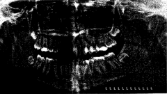 Why is this a bad panoramic radiograph?