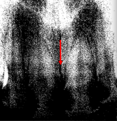 1) What structure is the arrow pointing to?


2) Describe the type and location.


3) Identify condition indicated by large radiolucent areas.