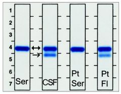 Immunofixation  with  transferrin  antibody  to  test  for  presence  of cerebrospinal  fluid  (CSF).  Ser,  Normal  serum  showing  position  of  transferrin  (Tf; double-headed  arrow);  CSF,  normal  position  of  Tf  and  asialotransferrin  (a...