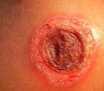 Dx?

			ii. More severe form of impetigo
			iii. Starts as pustule over inflamed skin
				1) → ulcer w/crust
			iv. From
				1) Strep pyogenes
				2) Staph aureus
			v. 
				1) MRSA
				2) Didn’t respond to cephalexin - switched to c...