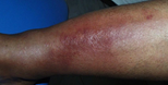 Dx?

				2) Infection of subcutaneous tissue
				3) Sx
					a) Redness
					b) Swelling
					c) Heat
					d) Tenderness
				4) Rapid spread via lymphatics - RED STREAKING
				5) Can dev → severe septicemia in 1-2d
				6) Legs - most co...