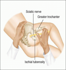 Patient lies on side and flexes hip to opposite side. 

The nerve lies midway between the greater trochanter and the ischial tuberosity as it leaves the pelvis through the sciatic notch.

Tenderness suggests herniated disc near L4-S3 nerve roots.