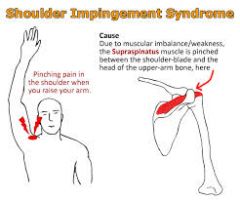 impingment syndrome