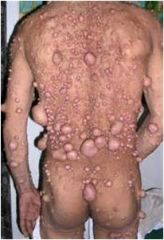 - Café-au-lait spots (discolored patches of skin)
- Skin tags
- Fibrous tumors