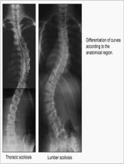 Lateral and rotatory curvature of the spine to bring the head back to midline.

Often becomes evident during adolescence, before symptoms appear.

Deformity of the thorax on forward bending.