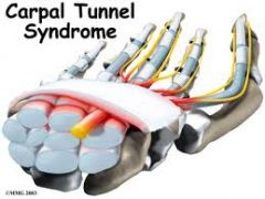 carpal tunnel syndrome pts would find pain in which digits?