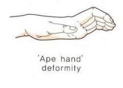 what is ape hand deformity?