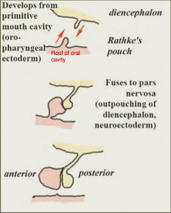 Pituitary cyst of Rathke's pouch