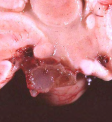 Identify the lesion and what does it lead to?
Lesion:
Causes: