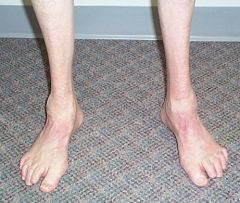 The physical exam and clinical photo are consistent with a cavovarus foot deformity associated with Charcot-Marie-Tooth (CMT) disease. The Coleman block test reveals a flexible hindfoot deformity, which suggests that soft-tissue transfers and not ...