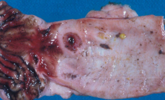 The black tarry blood seen in this ulcer can eventually lead to what?

What predisposes a dog or cat to ulcers?
