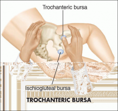 With the patient resting on one side and the hip flexed and internally rotated, palpate T. bursae
- Focal tenderness over the trochanter indicates trochanteric bursitis.