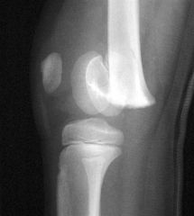 The clinical presentation, physical exam, and radiographs are consistent with a Salter-Harris Type I fracture of the distal femoral physis. The radiographs show subtle physeal widening, but no displacement. If there is no displacement following th...