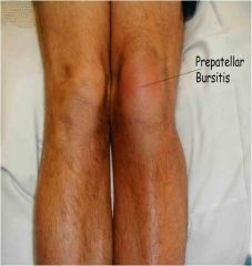 Swelling over the patella

Housemaid's knee, caused by excessive kneeling
