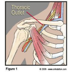 subclavian artery, subclavian vein, brachial plexus 


 


-thoracic outlet syndrome (weak, numb and tingly in upper limb) 