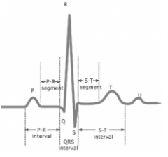 Recording of the electrical current as APs pass through the heart
P wave - atrial depolarization (atrial contraction)
QRS Complex - ventricular depolarization and atrial repolarization (ventricular contraction & atrial relaxation)
T wave - vent...
