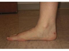 Hx:12yo B c/o 2yr x hx foot pain that prevent participation in athletic activities and is symptomatic with walking. UCBL and custom made orthoses for 1 year with no relief of sx. His hindfoot is supple and he has full dorsiflexion. Clinical images...