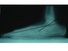 clinical presentation is consistent with pediatric flexible pes planovalgus, or flatfoot. The vast majority of these cases are asymptomatic and do not require treatment, and Level 1 evidence shows no benefit with corrective orthotics. In rare situ...
