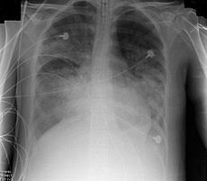 1-ARDS
2-bilateral pulmonary infiltrates, normal sized heart