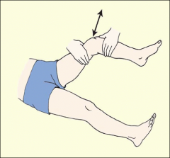 Place the knee in 15° of flexion and external rotation. Grasp distal femur with one hand and upper tibia with the other. With the thumb of the tibial hand on the joint line, simultaneously move the tibia forward and the femur back. 

Estimate t...