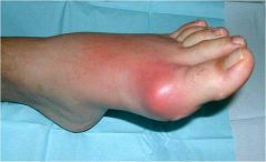 Podagra
- metatarsophalangeal joint of the great toe may be the first joint invovled. 

Very painful, erythematous, hot, and tender
- Can be mistaken for septic arthritis.
- Look at risk factors for gout
- Disease of kings-lots of alcohol an...