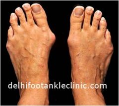 Great toe is abnormally abducted in relationship to the first metatarsal, which itself is deviated medially. 

Head of metatarsal may enlarge and from a bursae. 

Pain and edema, with deformity