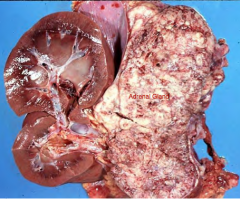 Tumor arising from adrenal cortex with atrophy of the unaffected contra-lateral gland. 
Name this lesion.