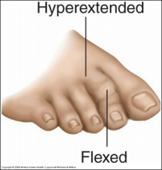 Hyperextension at the MTP joint with flexion at the PIP (usually 2nd toe)