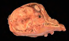 Tumor arising from adrenal cortex with atrophy of the unaffected contra-lateral gland. 
Dx: