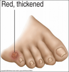 Painful conical thickening of skin from recurrent pressure (usually 5th toe).

Cauliflower look when you scrape corns