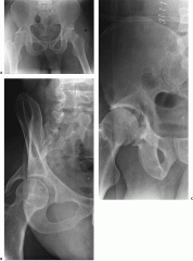 1-Dx/xrayF/ pathomneumic F & CTF (counterclockwise)
1.1 best method to test stability
2-Tx/surgical approach/indications 
3-MCC
(5 elementary fx & accociated fx?)