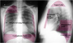 Right upper lobe

Other areas include retrocardiac, peripheral lung margins and posterior costophrenic sulci.