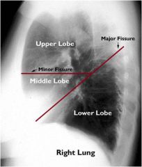 Fissures - best visualized on lateral
- Major separates upper from lower lobes
- Minor separates RUL from RML
- Azygos (0.5%), accessory