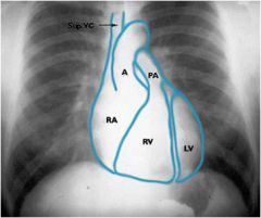 Right cardiac border - right atrium 

Left cardiac border - left ventricle  

The SVC forms a right paramedian border