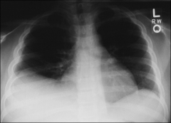 Apex of diaphragm laterally displaced due to subpulmonic effusion.
