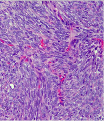 biphasic appearance with two typical cell types