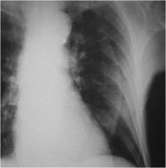 Pneumothorax or skin fold?
- Second view – inspiratory/expiratory views
- Hyperlucent lung – mastectomy may appear this way