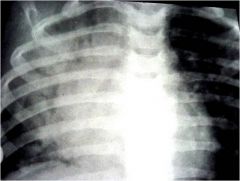 Indicates air space disease with fluid density outlining the air-filled bronchi.

Shown: right middle lobe pneumonia