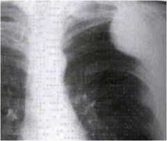 A mass outside the pleural space has characteristic, smoothly sloped margins.