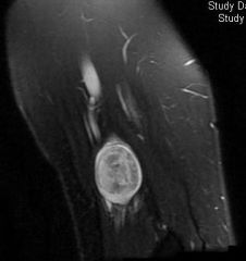 positive S100 stain
keratin staining is negative
- The MRI shows the classic "target sign" on fluid sensitive imaging.
