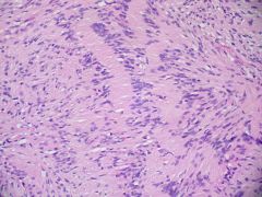 -Malignant Peripheral Nerve Sheath Tumor,  peripheral nerve or neurofibroma aka. neurofibrosarcoma or malignant schwannoma
-wide surgical resection + radiation, in general, treated as high-grade sarcoma, chemotherapy not useful
spindle cells ...