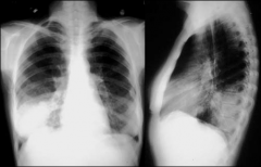 Very dense, masslike
Acute
- Pneumonia
- Blood
- Atelactesis 

Chronic
- Lymphoma 
- BAC (bronchioloalveolar carcinoma cell)

Order follow up x-ray to see if consolidation has cleared
