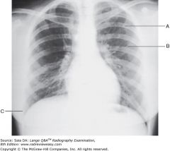 The PA chest radiograph shown in Figure 2–13 demonstrates
1.rotationscapulae 
2.superimposed on lung fields
3.adequate inspiration